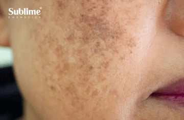 L'hyperpigmentation hormonale : comprendre et traiter le mélasma